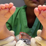 Clubfoot or Congenital Talipes Equinovarus (CTEV)