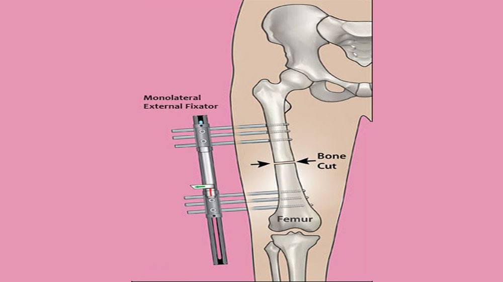 External fixation procedure for fracture treatment