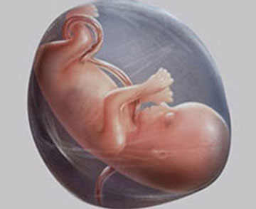 Clubfoot risk factors illustration