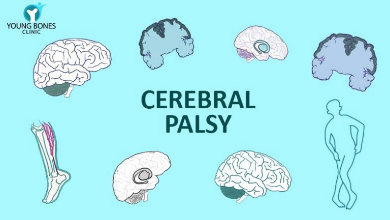 Cerebral Palsy Treatment in Gurgaon, Delhi | Young Bones Clinic