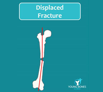 The displaced fracture​