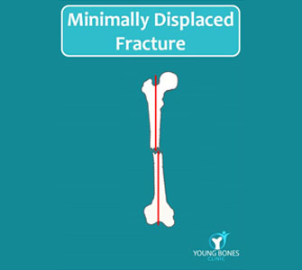 Minimally displaced fracture​