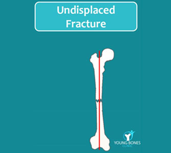 The Un-displaced fracture
