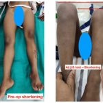 A case of Untreated Developmental Dysplasia of hip (DDH) in a 6yr old