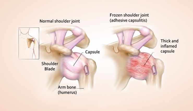 Causes of frozen shoulder