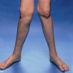 Knock Knees- Everything you need to know