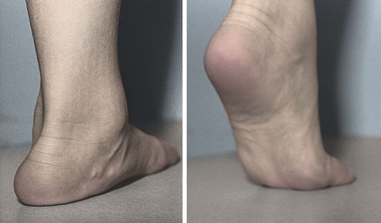Flexible flat feet example