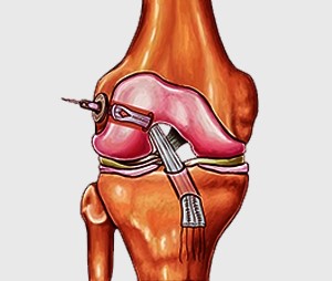 X-ray and MRI for ACL diagnosis