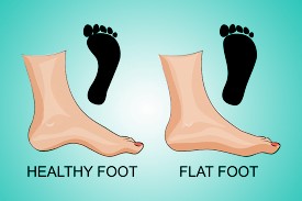 Flatfeet