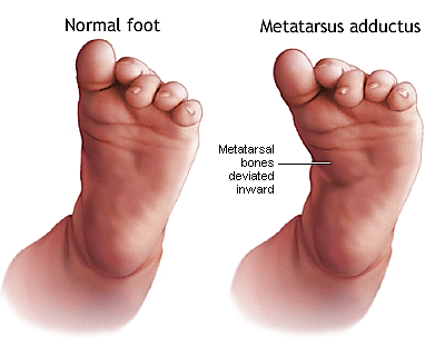 Metatarsus adductus