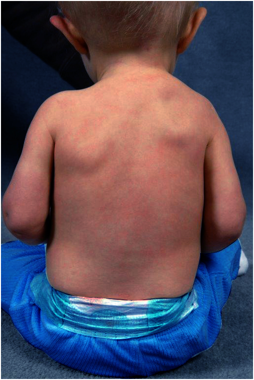 Sprengel shoulder raised shoulder blade