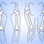 Bow Knees – Everything you need to know