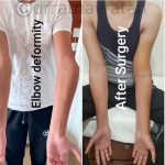 A Case of a 22-Year-old Boy with an Elbow Deformity since Childhood