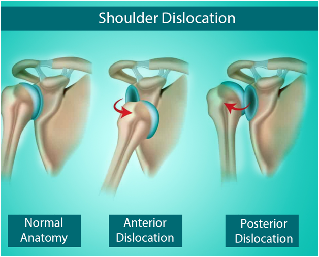 Shoulder Dislocation Treatment in Gurgaon, Delhi Young Bones Clinic