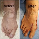 A Case of a 55-Year-old Woman with a Severe Deformity of Great Toe