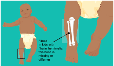 born without fibula