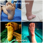 A 9-Year-Old with Left Foot Deformity Treated with Corrective Surgery