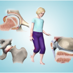 What are the Common Causes of Limping in Children?