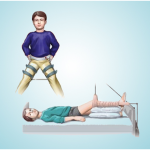 Perthes Disease – All you need to know