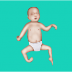 Diagnosis of arthrogryposis condition