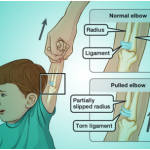 Pulled Elbow: All you need to know
