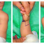 Radial Club Disease