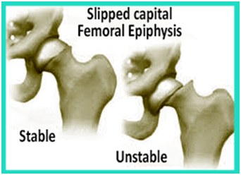 Slipped Capital Femoral Epiphysis condition