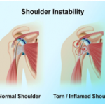Causes of shoulder pain in teens and adolescent kids