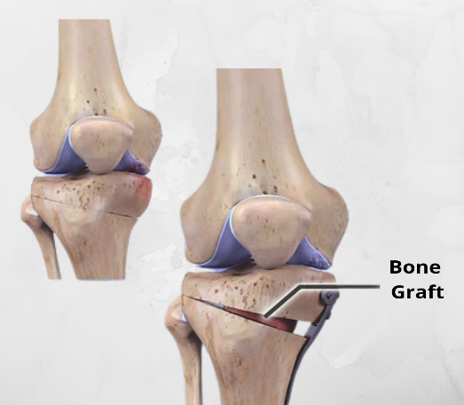 Surgical Treatment of Bone Cysts