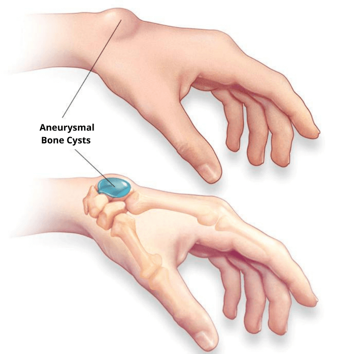 Bone cysts illustration