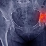 Slipped Capital Femoral Epiphysis – Occurrence, Treatment & Complications