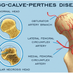 All about Legg-Calve-Perthes disease, a rare hip condition in growing children