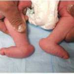 Treatment of rocker-bottom foot condition in newborns and children