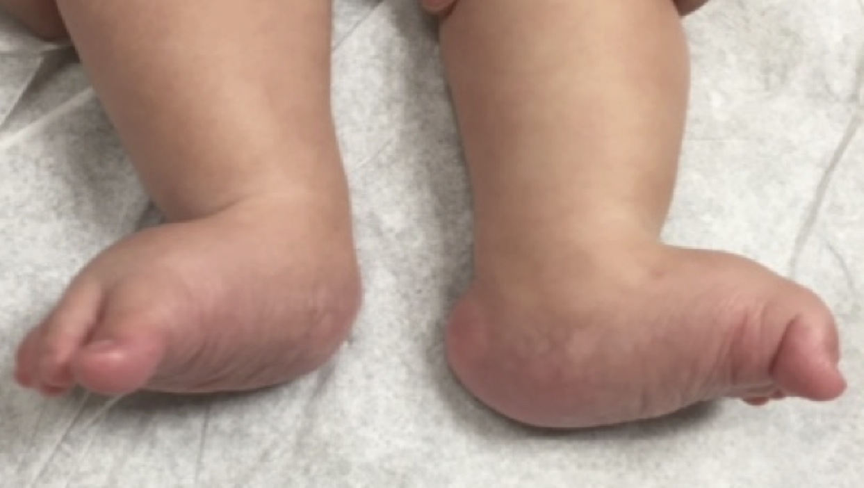 Treatment of rockerbottom foot condition in newborns and children Dr
