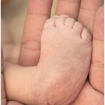What to do if your baby is found to have Clubfoot when you are pregnant?