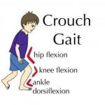 Crouch gait in children with Cerebral Palsy