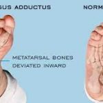 Metatarsus adductus in children