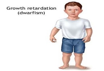 disproportionate dwarfism pictures
