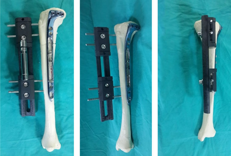 Bone Lengthening All You Need to Know Dr. Ratnav Ratan