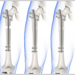 Bone Lengthening:  All You Need to Know