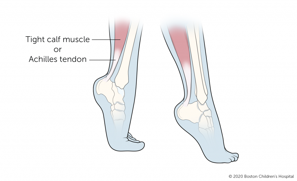  Achilles tendon