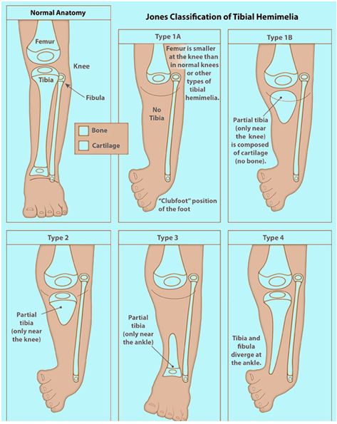 Tibial hemimelia condition
