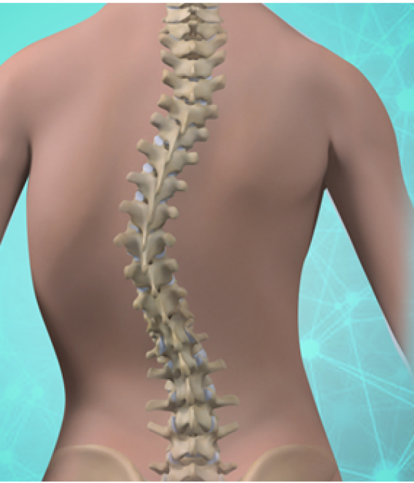 Scoliosis